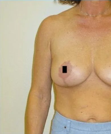 Woman's torso with a reddish skin patch on breast, wearing blue jeans.