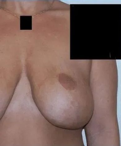 Torso of a person with a necklace and a darker spot on the breast. Some areas are covered by a black square.