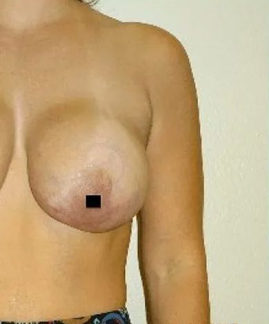 Bare chest, black square obscuring nipple on the right breast.