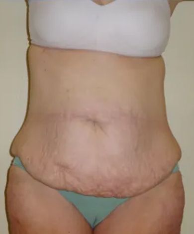 Torso of a person with loose skin on the abdomen, wearing a white bra and teal underwear.