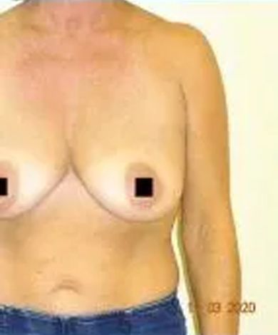 Upper torso of a person with visible scars on chest, nipples obscured by black rectangles.