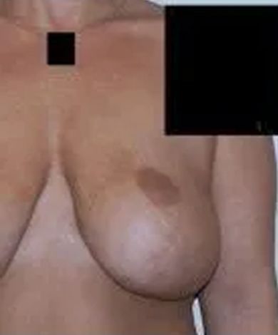 Chest and upper torso with a large brown skin discoloration on the breast.