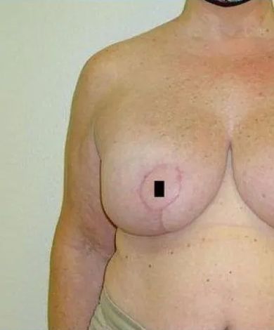 Torso of a person with a breast and a dark mark, possibly a scar, on it.