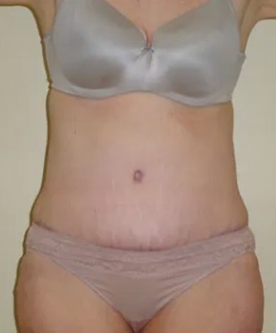 Woman's torso in underwear and bra. Visible stretch marks and incision scar, beige tones.