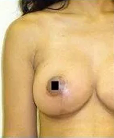 Torso with a partially visible breast and a black square covering the nipple.