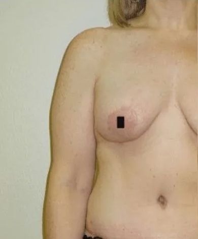 Torso of a person, facing forward. One nipple is blacked out.