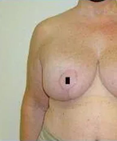 Torso of a person with a breast. The areola has a dark square.
