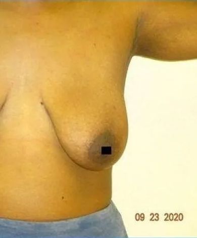 Side view of a breast; brown skin, dark areola, and date stamp '09 23 2020.'