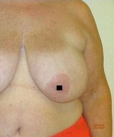 Close-up of a person's torso, featuring a breast with a dark square over the nipple. Skin is light-toned.