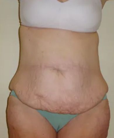 Torso with loose skin and surgical scar, wearing a white bra and teal underwear.