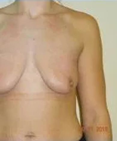 Torso of a person with breasts, showing chest and arm, against a neutral background.