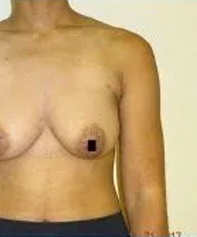 Torso with two breasts, one nipple obscured by a black square. Right arm is visible.