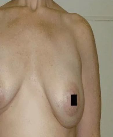 Bare torso; right breast with a black square covering the nipple.