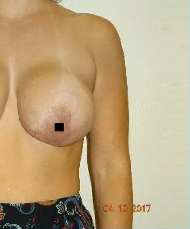 Woman's torso with exposed breasts. Right nipple has a black square covering it. Date stamp in bottom right corner.