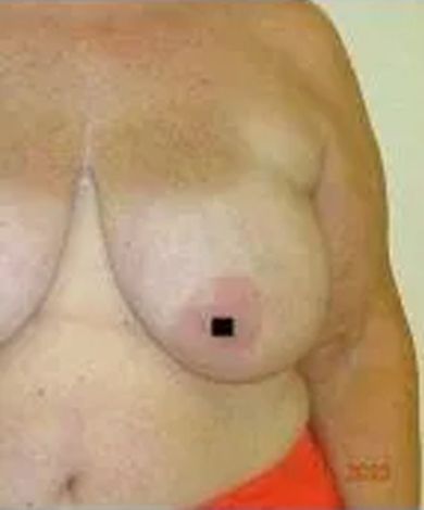 Torso of a person, showing a breast with a small black square over the nipple. Skin is light-colored.