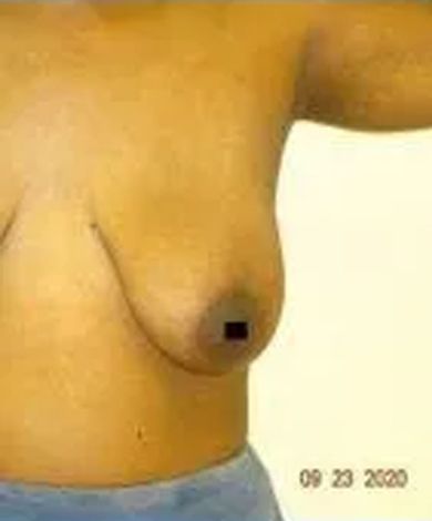 Close-up of a person's torso and breast; date '09 23 2020' in the bottom right corner.