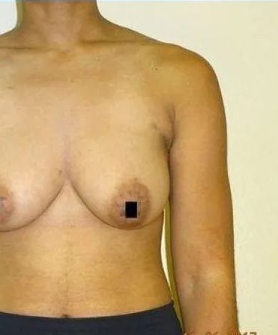 Chest and shoulder of a person with a dark spot over a nipple, set against a light background.