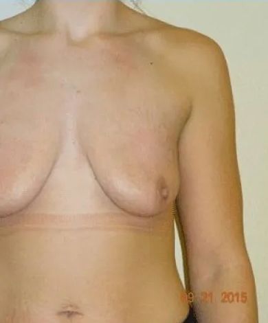 A person's upper body from the chest up, skin-toned, showing breasts and a part of the arm.