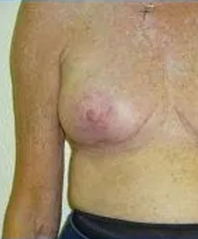 Torso with skin discoloration and visible breast tissue.