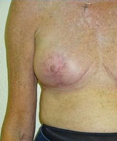 A person's torso and left arm are visible, showing a reddish, enlarged breast and a surgical scar.