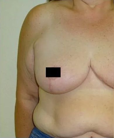 Chest of a person, partial view. One breast visible, covered nipple area.
