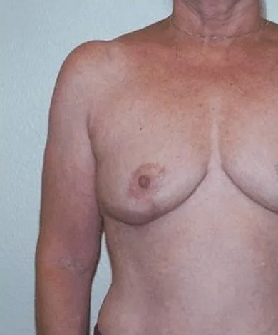 Torso of a person, tanned skin, two breasts visible, one nipple showing, arm at side.