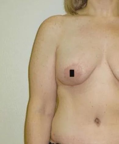 Torso of a person with a partially visible left breast. A black square obscures the nipple.