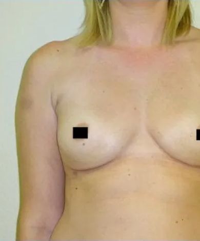 Torso of a person, breasts are partially visible with black boxes covering nipples, fair skin.