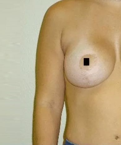 Nude torso of a person with a breast and arm visible. A small black square covers the nipple.