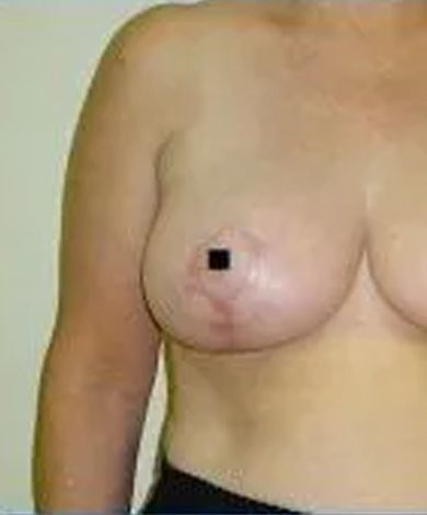 Woman's torso, close-up, revealing the chest with a dark square obscuring a nipple.