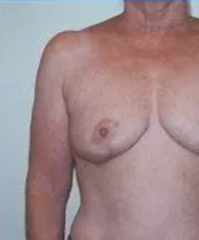 Chest and left arm of a person, skin tone with freckles, possibly showing a health condition.