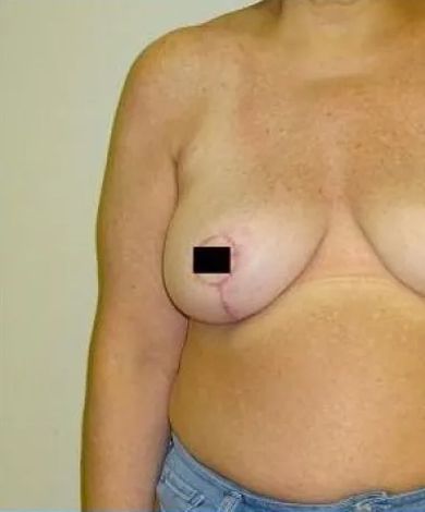 Woman's torso with a mastectomy scar on the left breast, black box covering the nipple.