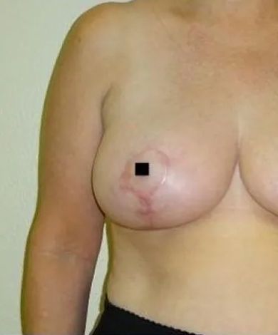Torso of a person with a breast showing a discolored area. A black square obscures the nipple.