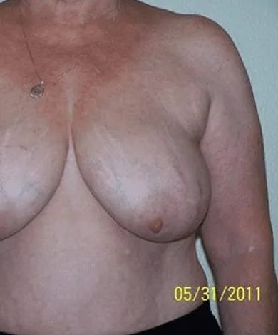 A person's bare chest. Skin has discoloration and stretch marks. Date stamp: 05/31/2011.