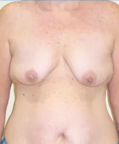 Torso of a person with light skin, showing breasts and abdomen. Skin has freckles.