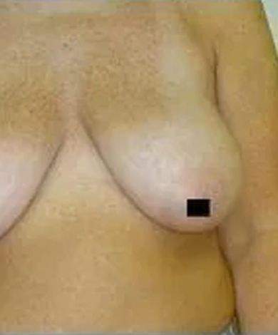 Torso with breast, nipple covered by black square.