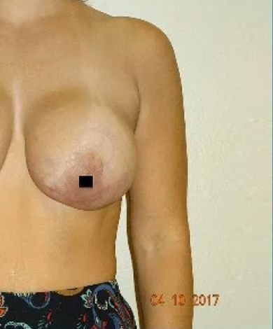 Woman's bare chest with one nipple obscured by a black square. She is wearing a patterned skirt.