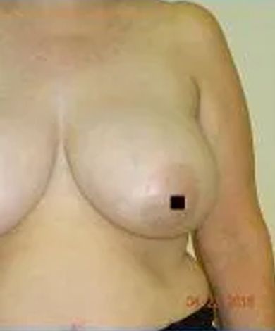 Close-up of a person's chest, showing one breast with a small black square covering the nipple.