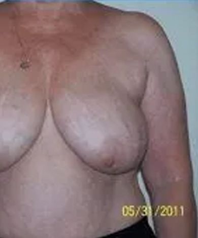 Torso of a person, breasts are visible. Skin tone is light with stretch marks. The date '05/31/2011' is visible.
