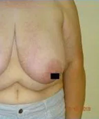 Torso of a person with a visible breast, with a small black square covering a nipple.