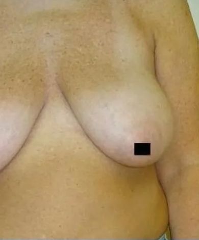 Close-up of a person's torso, breasts visible, with a small black square covering a nipple. Skin is tan-colored.