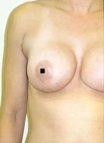 Torso of a person with bare chest, nipple obscured by a black square.