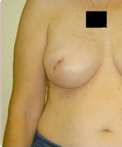 Torso with a breast; nipple visible. Chest skin has some freckles.