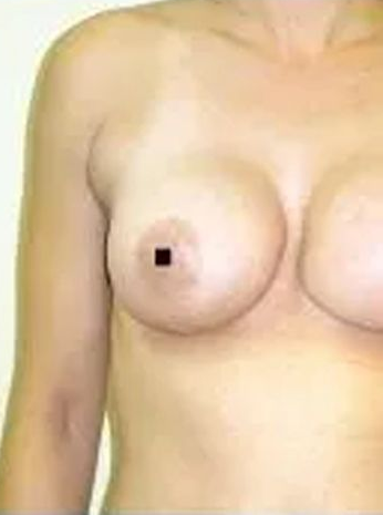 A woman's bare torso with two breasts; a dark square covers the left nipple.
