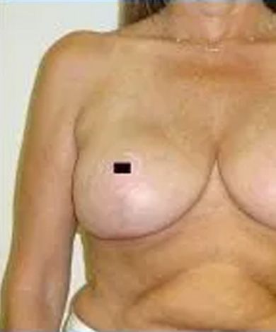 Woman's bare chest with slight wrinkles and a small black square covering a nipple.