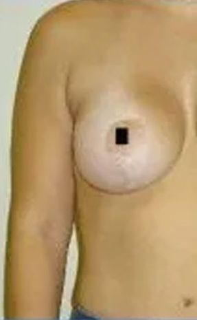A person's bare chest and right arm are shown. A black square obscures the nipple.