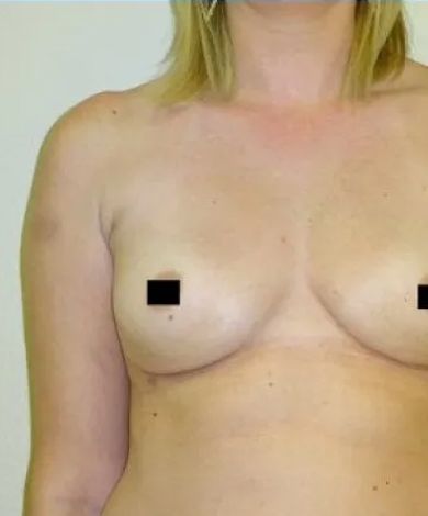 Torso of a person with bare breasts, small black squares cover nipples.