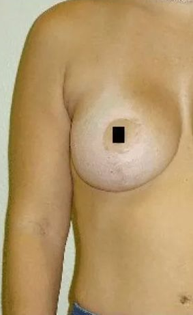Torso of a person, right breast visible with a black square over the nipple.