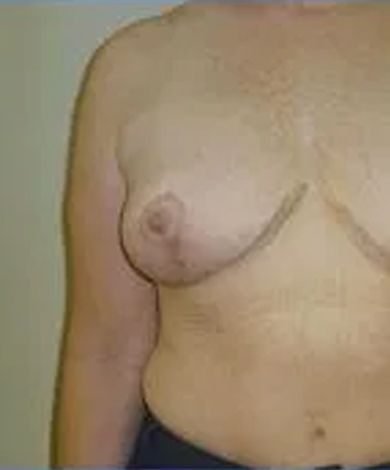 Torso, chest, and arm of a person. Visible breast tissue, likely post-surgery, with surgical markings.