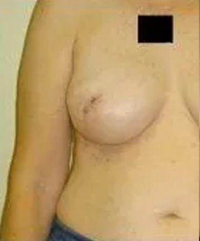Upper torso of a person with a breast and an arm, with the nipple visible. The other nipple is obscured.